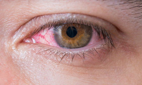 Ocular Trauma and Emergencies - English Rows Eye Care 