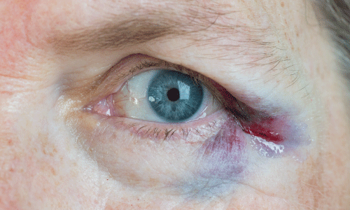 Ocular Trauma and Emergencies - English Rows Eye Care 